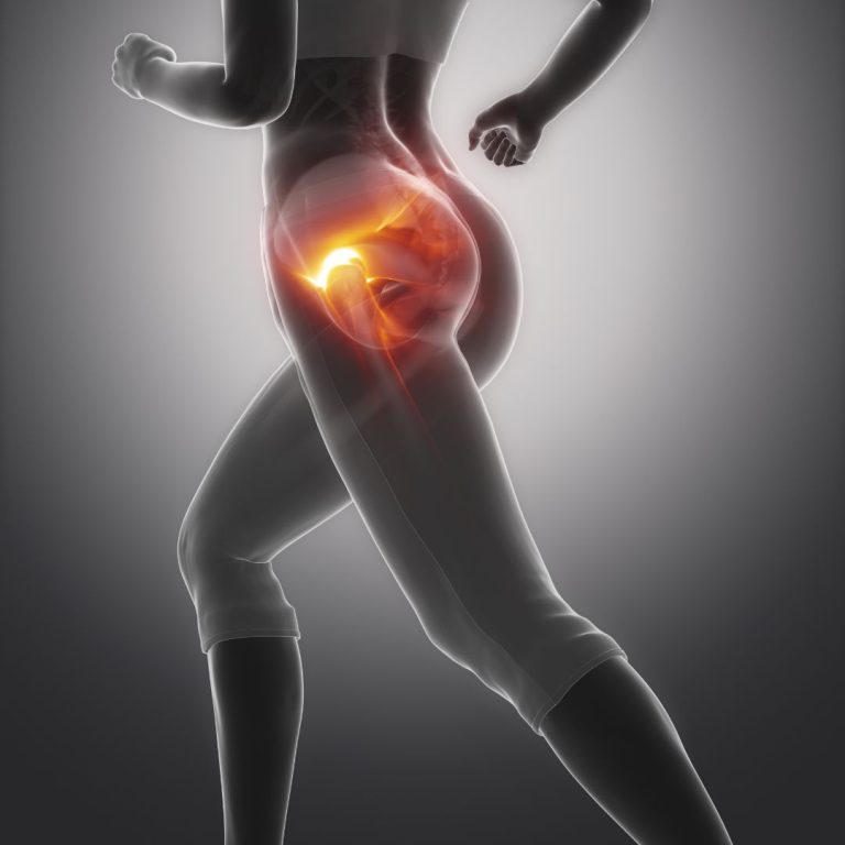 How Long Does Piriformis Syndrome Last? [Recovery & Treatment Tips]