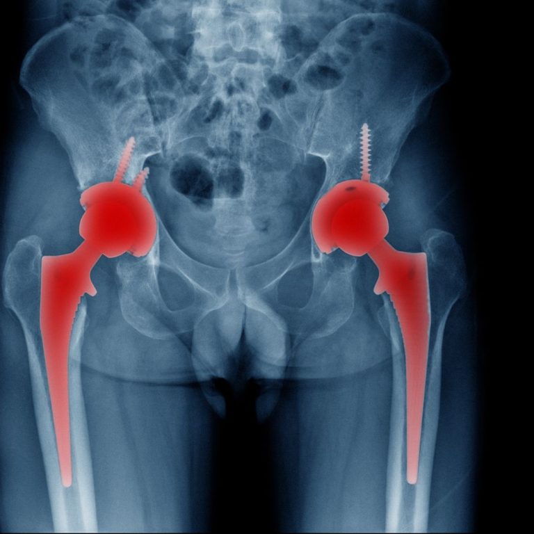 Can You Run After a Hip Replacement? [Everything You Need to Know]